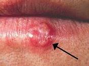 Herpes labial