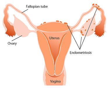 Que es la Endometriosis