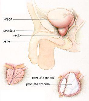 Para un 94% de los españoles es importante el diagnóstico precoz de cáncer de próstata