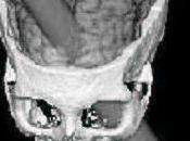 Curiosidad. traumatismo craneal famoso historia