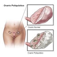 Sindrome de Ovarios Poliquísticos