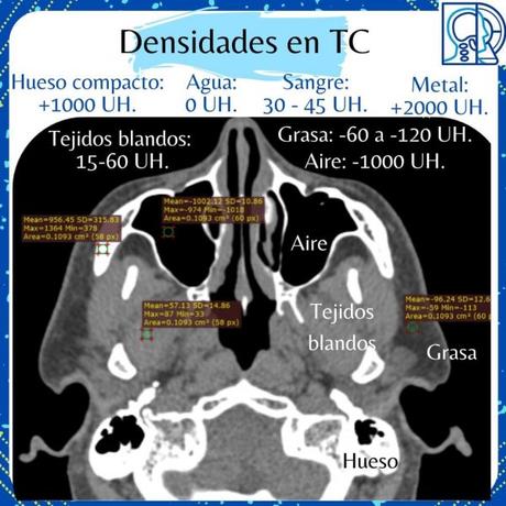 TOMOGRAFÍA DENSIDADES