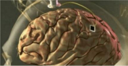Apuntes sobre Brain-Computer Interface (II): Técnicas Invasivas