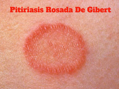 Pitiriasis rosada de Gibert, mi experiencia