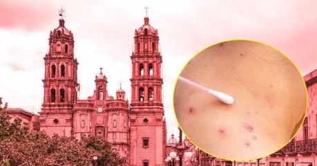 San Luis Potosí registra el primer caso de viruela del mono (símica)