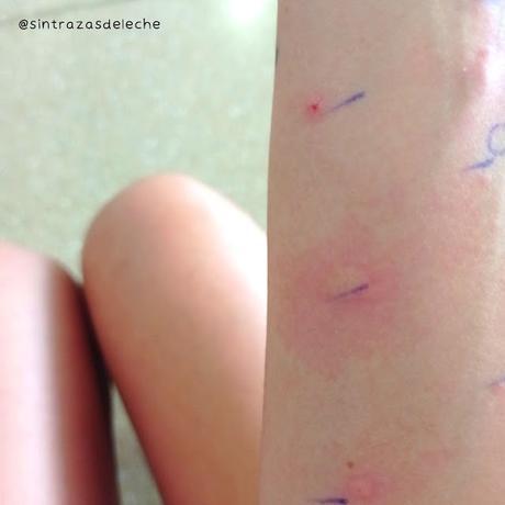 ¿Qué son los Prick Test? ¿Qué son los Prick Test?