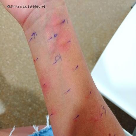 ¿Qué son los Prick Test? ¿Qué son los Prick Test?