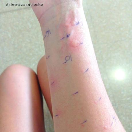 ¿Qué son los Prick Test? ¿Qué son los Prick Test?