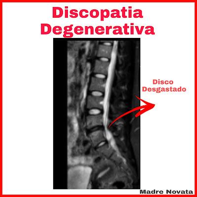 Discopatía Degenerativa En L5-S1... Dolor Lumbar. Discopatía Degenerativa En L5-S1... Dolor Lumbar.