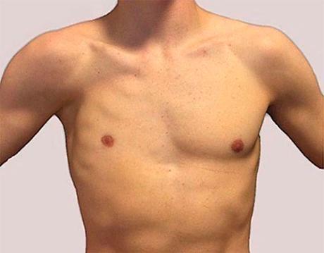 Síndrome de Poland: caracterísitcas y tratamiento sindrome poland