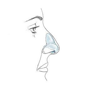 Los cirujanos plásticos defienden las técnicas poco invasivas  para operar la nariz