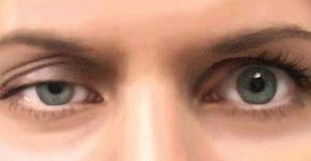 Miastenia-gravis La miastenia grave: una patología que va perdiendo gravedad