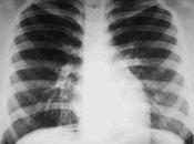 edema pulmonar