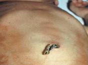 Probióticos disminuyen riesgo muerte desarrollar enterocolitis necrosante