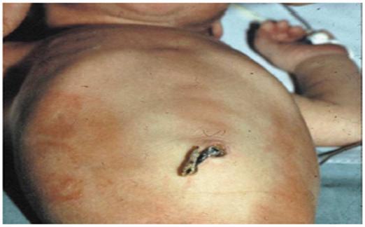 Probióticos disminuyen el riesgo de muerte y de desarrollar enterocolitis necrosante