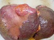 Carcinoma hepatocelular sobrevida