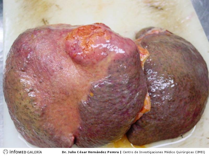 Carcinoma hepatocelular y sobrevida