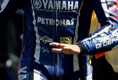 dedo de Jorge Lorenzo tras accidente