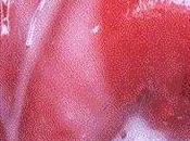 Relación vaginosis bacteriana parto ruptura membranas prematuros