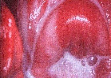Relación de la vaginosis bacteriana con el parto y la ruptura de membranas prematuros