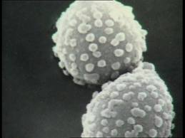 Estudio MÓNICA demuestra la mejora de calidad de vida y función pulmonar en pacientes asmáticos