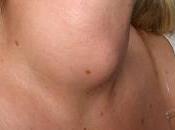 Manejo Nódulo Tiroideo