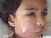 Infecciones cervicofaciales origen dental