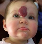 Uso de propanolol en hemangiomas infantiles