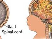 Diagnóstico meningitis
