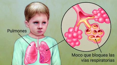 ¿Qué es la Fibrosis Quística y cómo se aborda su tratamiento?