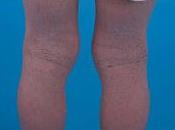 Novedoso Tratamiento para Dermatitis Atópica