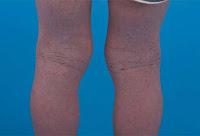 Novedoso Tratamiento para la Dermatitis Atópica