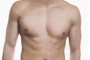 La ginecomastia, una operación de estética cada vez más común entre los hombres