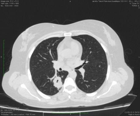 TAC Infección pulmonar por complejo Mycobacterium avium TAC Infección pulmonar por complejo Mycobacterium avium