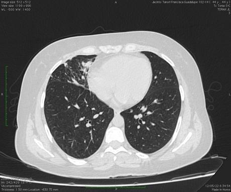 TAC Infección pulmonar por complejo Mycobacterium avium TAC Infección pulmonar por complejo Mycobacterium avium