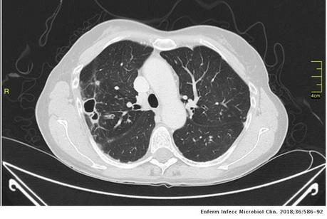 TAC Infección pulmonar por complejo Mycobacterium avium TAC Infección pulmonar por complejo Mycobacterium avium