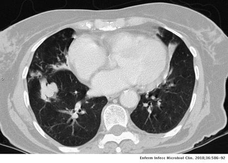 TAC Infección pulmonar por complejo Mycobacterium avium TAC Infección pulmonar por complejo Mycobacterium avium