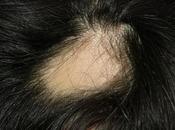 alopecia areata, causas tratamientos