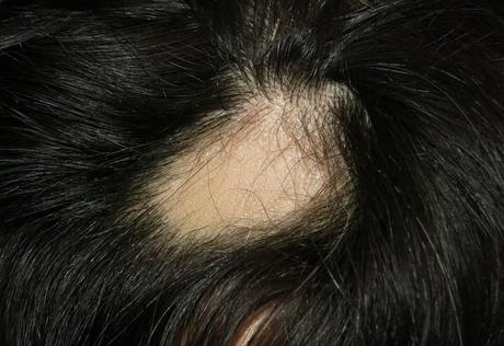 Qué es la alopecia areata, causas y tratamientos Síntomas de la alopecia areata