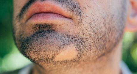 Qué es la alopecia areata, causas y tratamientos Tratamiento de alopecia areata