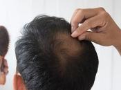 Alopecia difusa hombres