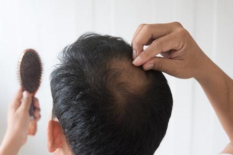 Alopecia difusa en los hombres 6