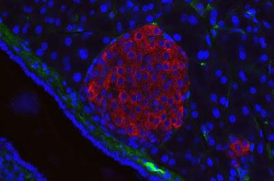 Mejoran la Diabetes usando trasplantes de islotes Pancreáticos