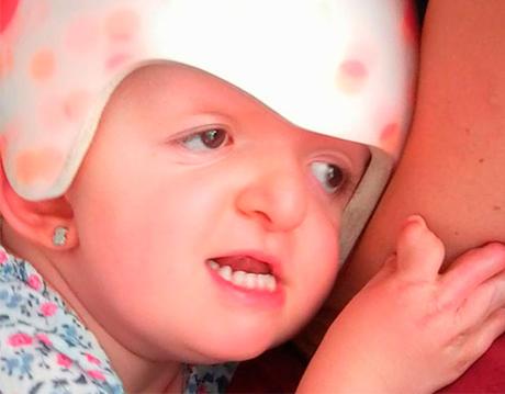 Síndrome de Apert Sindrome Apert