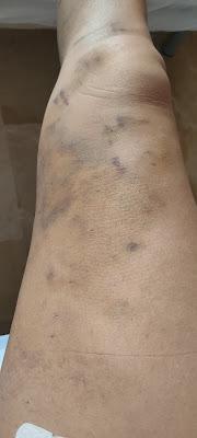 Mi operación de varices: Te cuento 04