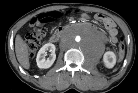 LINFOMA NO HODGKIN DE CÉLULAS B LINFOMA NO HODGKIN DE CÉLULAS B