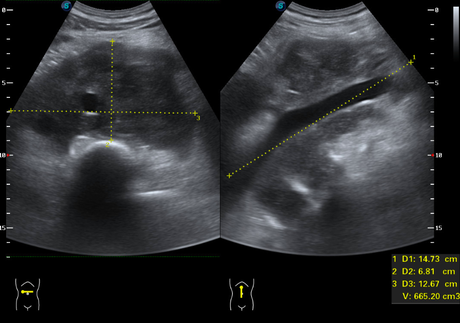 LINFOMA NO HODGKIN DE CÉLULAS B LINFOMA NO HODGKIN DE CÉLULAS B