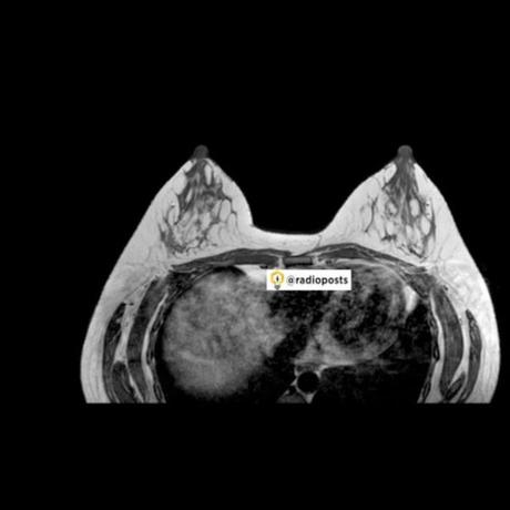 anatomía de mama en RM