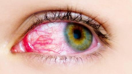 remedios naturales para la conjuntivitis