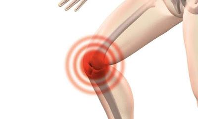 Bloqueo anestesico alivia el dolor de la artrosis de rodilla